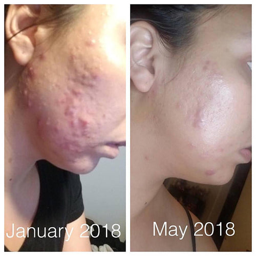 Organic Acne Treatment – Super Acne Fighter Serum