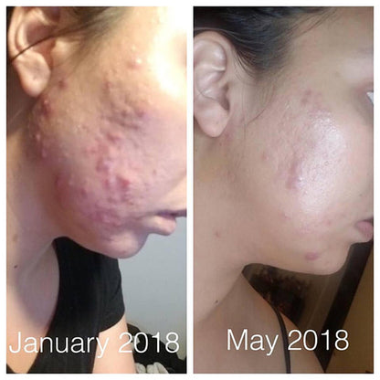 Organic Acne Treatment – Super Acne Fighter Serum