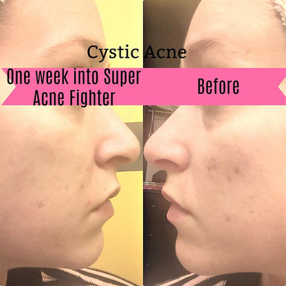 Organic Acne Treatment – Super Acne Fighter Serum